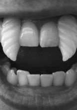 Scarecrow Halloween Spiral Fangzähne Del